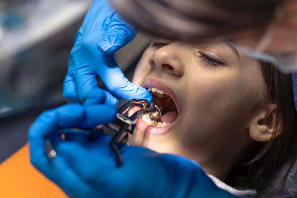 Composite Restorations