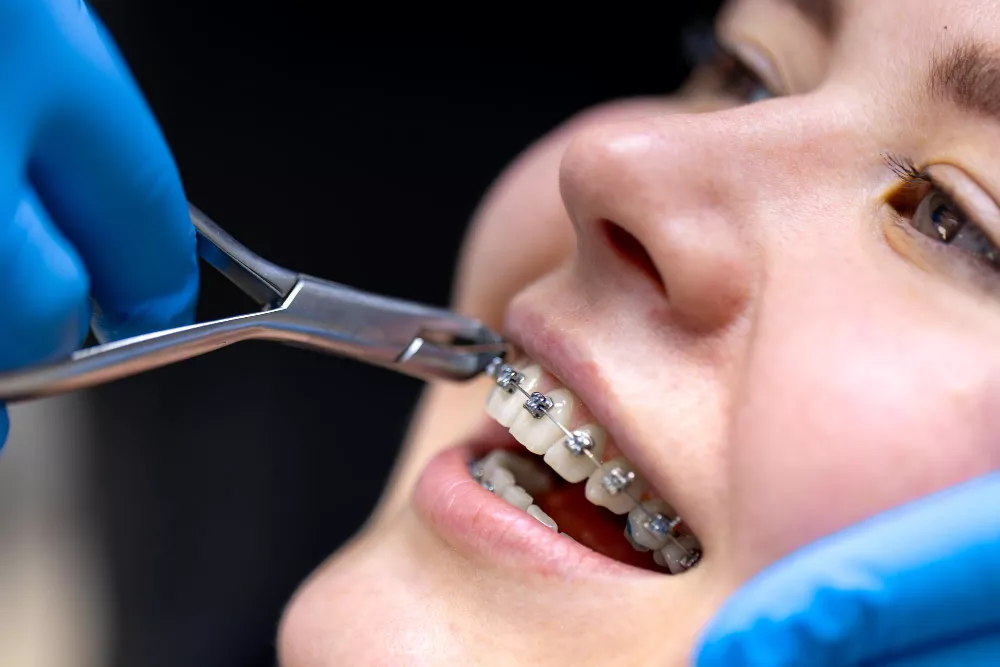Orthodontics (Braces & Aligners)
