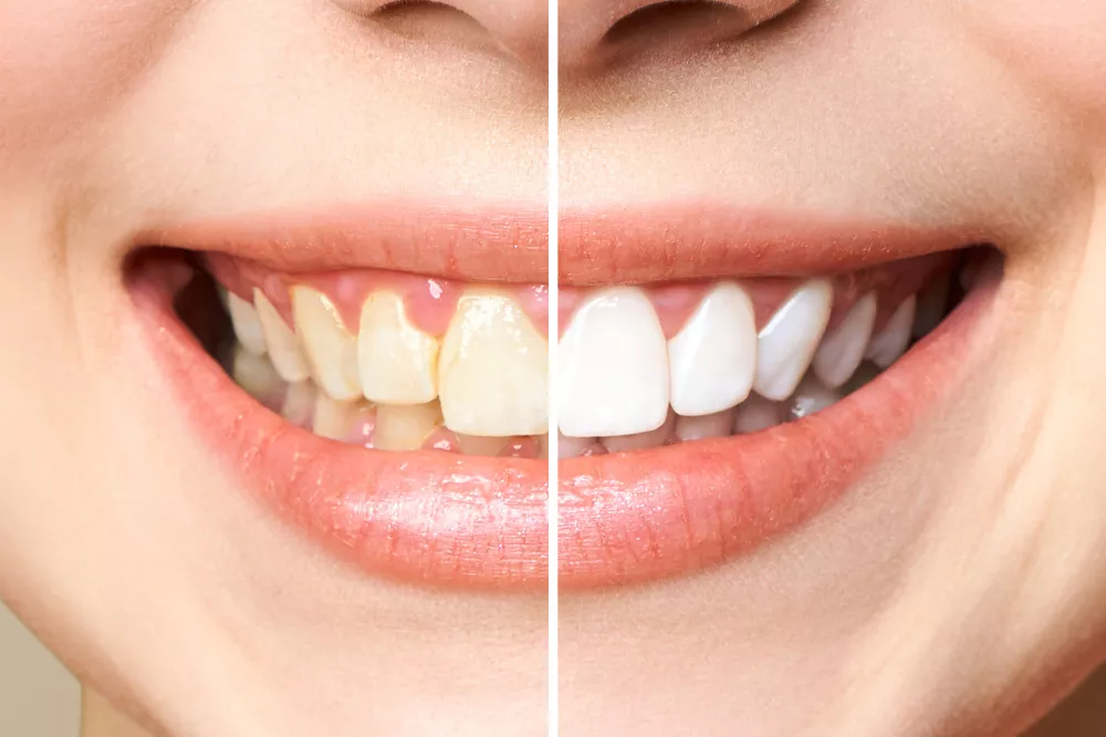 Cosmetic Teeth Whitening